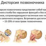 Дисторсия занимает 15-25% всех травм позвоночника