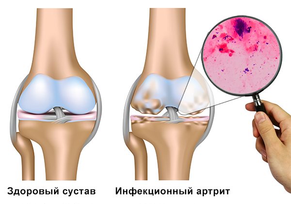Инфекционный артрит как причина боли в ступне