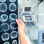Менингиома головного мозга: прогноз жизни, отзывы о лечении