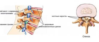 Ортопедический корсет для шеи обязательно применяется в терапии грыжи позвоночника, стеноза и остеохондроза