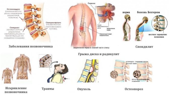 Распространенные заболевания позвоночика