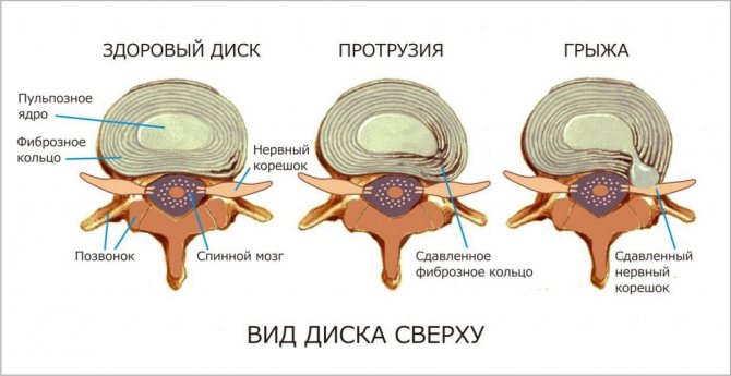 Здоровый диск, протрузия и грыжа